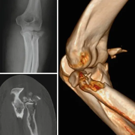3D CT Left Elbow